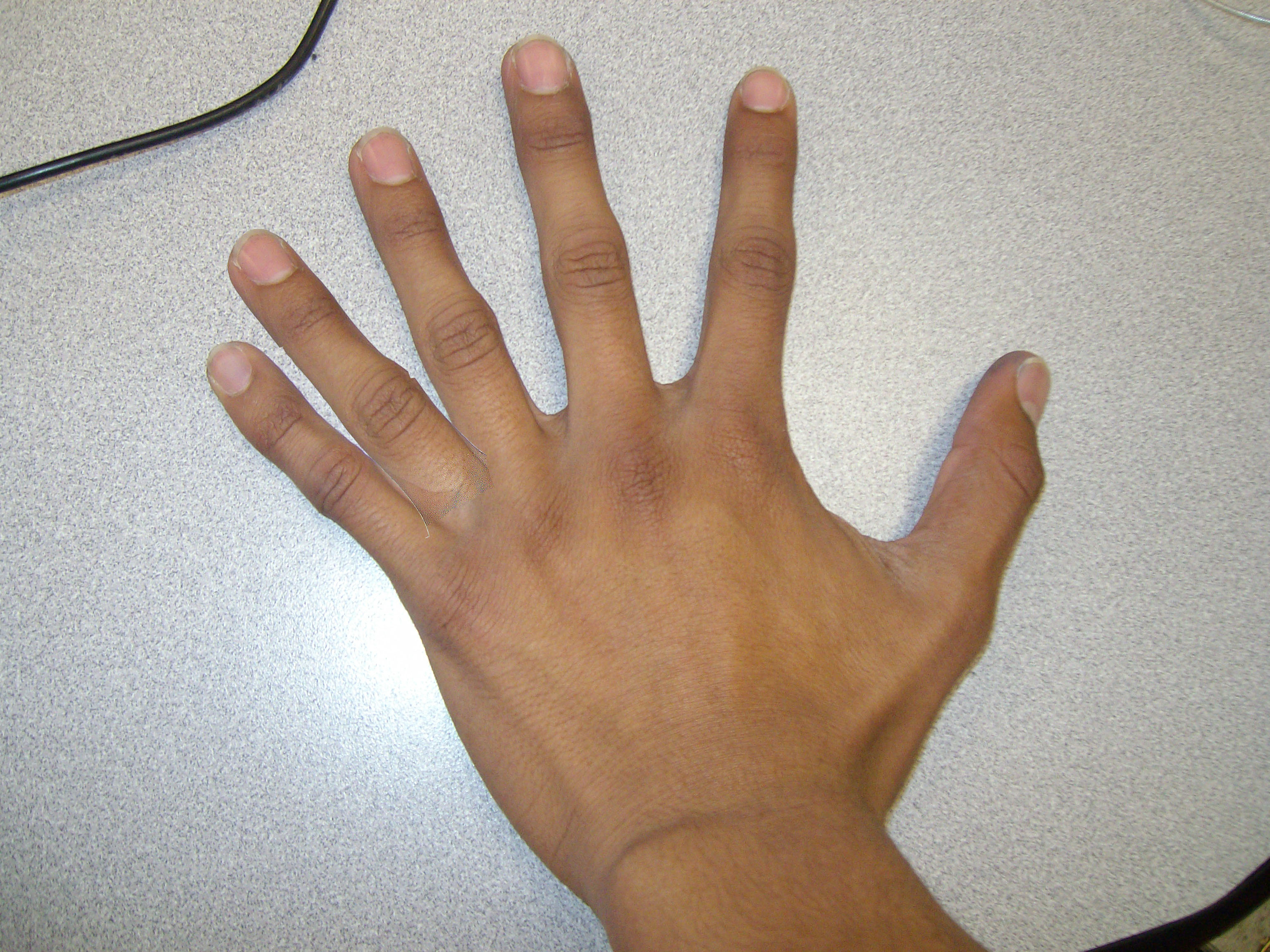 Выросли пальцы на руке. Полидактилия верхних конечностей. Полидактилия шестипалость.